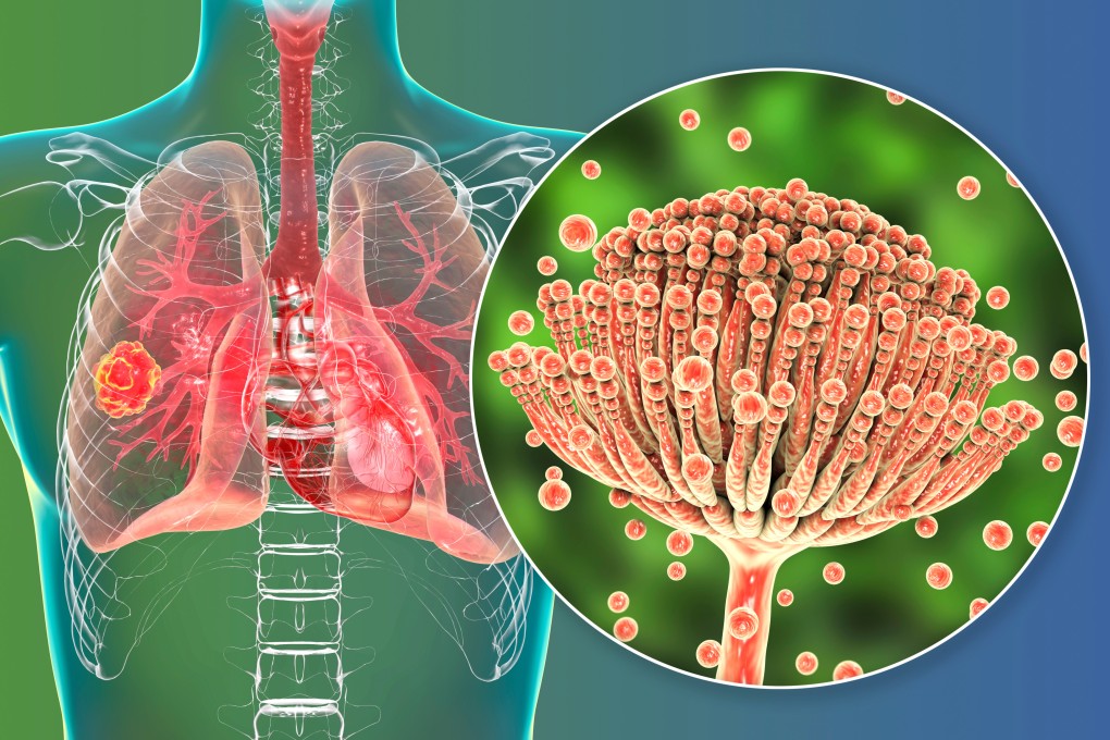 Dangerous, often fatal fungal diseases are becoming more common as antifungal drug resistance increases. Illustration: Shutterstock